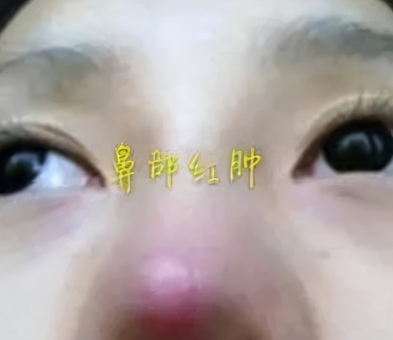 隆鼻科普你对自己的鼻型满意吗,隆鼻鼻子两侧发红