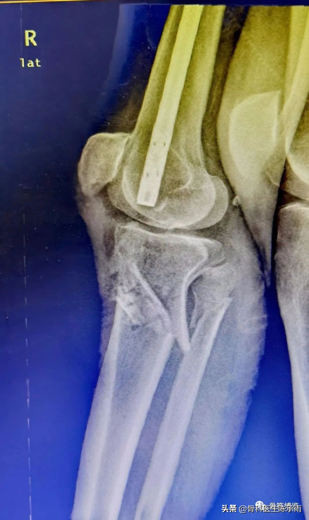 陈旧性腿骨骨折,陈旧性骨折