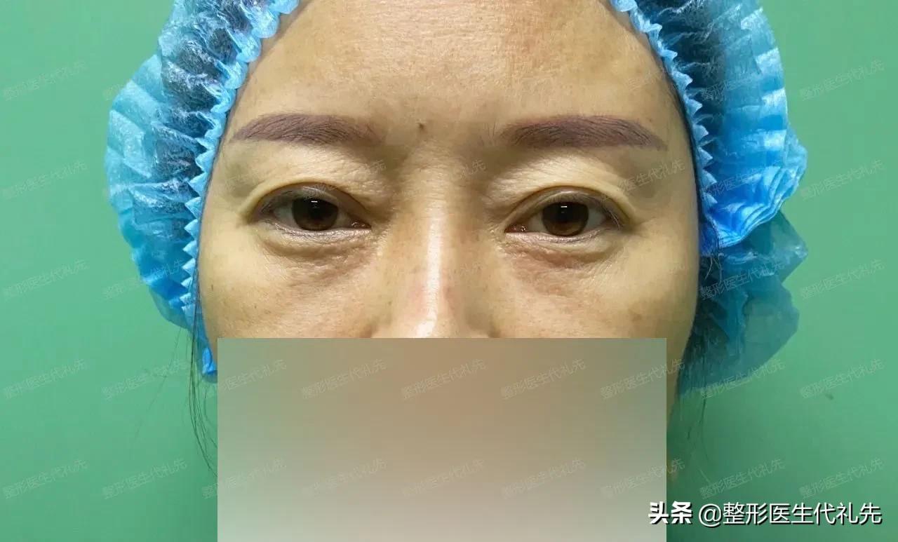45岁适合做双眼皮全切手术吗,55岁双眼皮手术前后对比