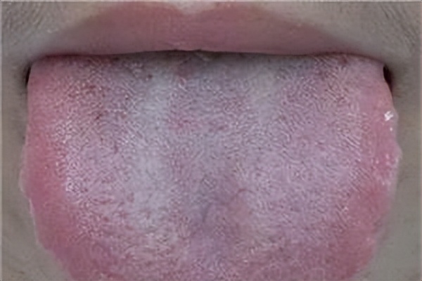 舌头有裂纹吃什么降火食物,舌头有很多裂纹中医怎么讲