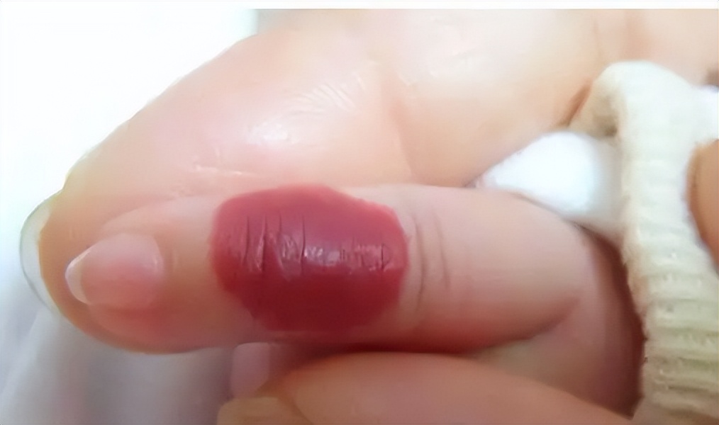 孩子颈部鼓起一个硬包图片,小孩颈部有鼓包颜色变重