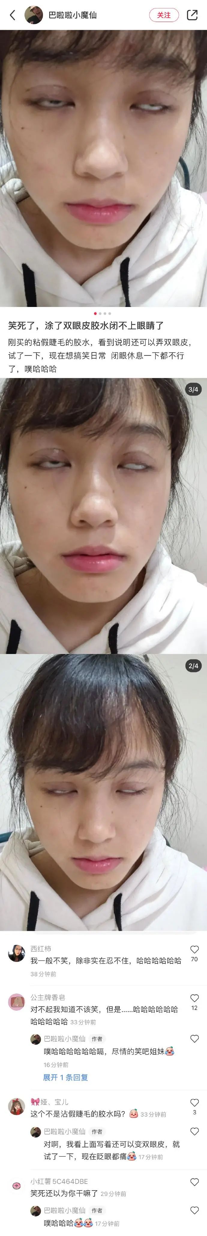 割包皮被反复收费,包皮手术为什么说是医疗骗局