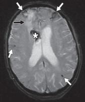 脑水肿的影像,脑水肿形成机制生理学