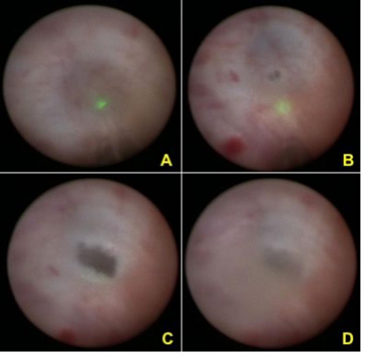男性梗阻性无精症可以人工授精吗,男科梗阻性无精症