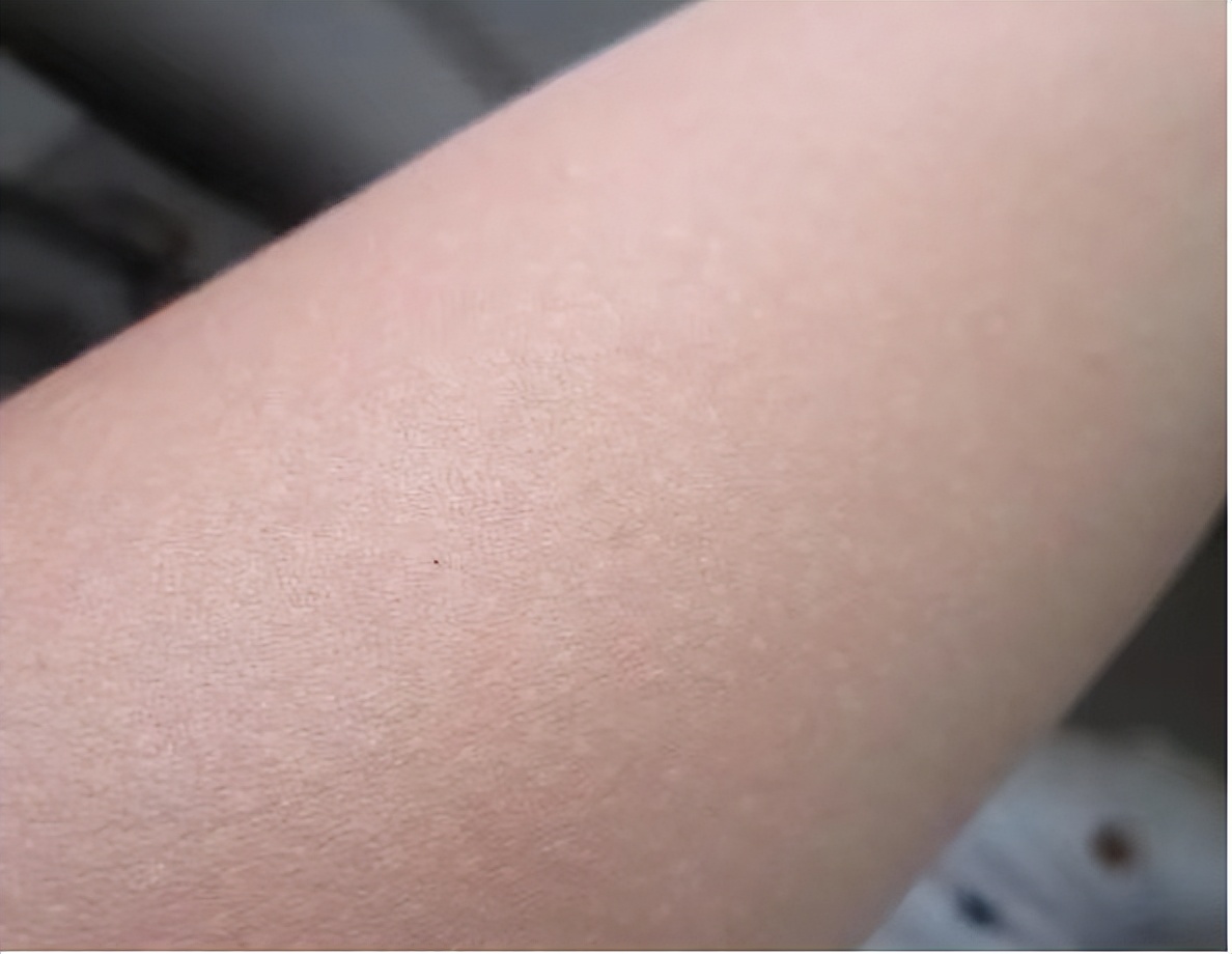 白癜风能去掉白斑吗,白癜风能不能去把皮肤刺破