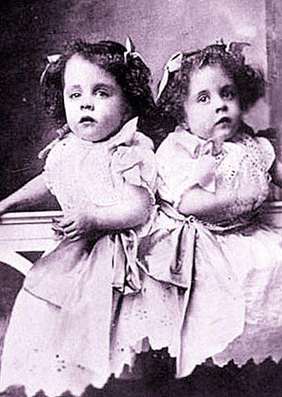 连体人一人去世了另一人会死吗,连体人死后另一半还能活下去吗