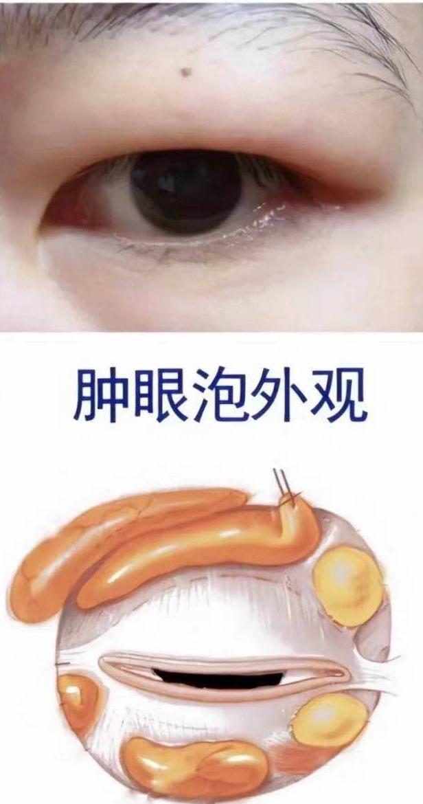 怎么分辨肿眼泡和内双眼皮,新手化妆单眼皮肿眼泡和谁学