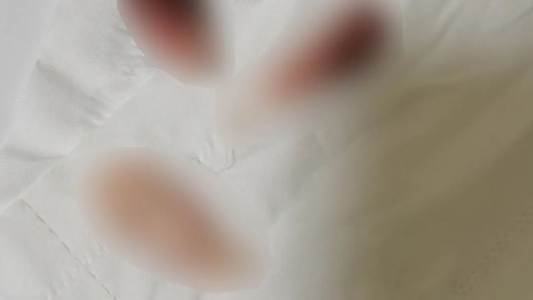 女子：“在海口一私立医院做手术，术后*体下**竟扯出3个棉签头”！涉事医院回应