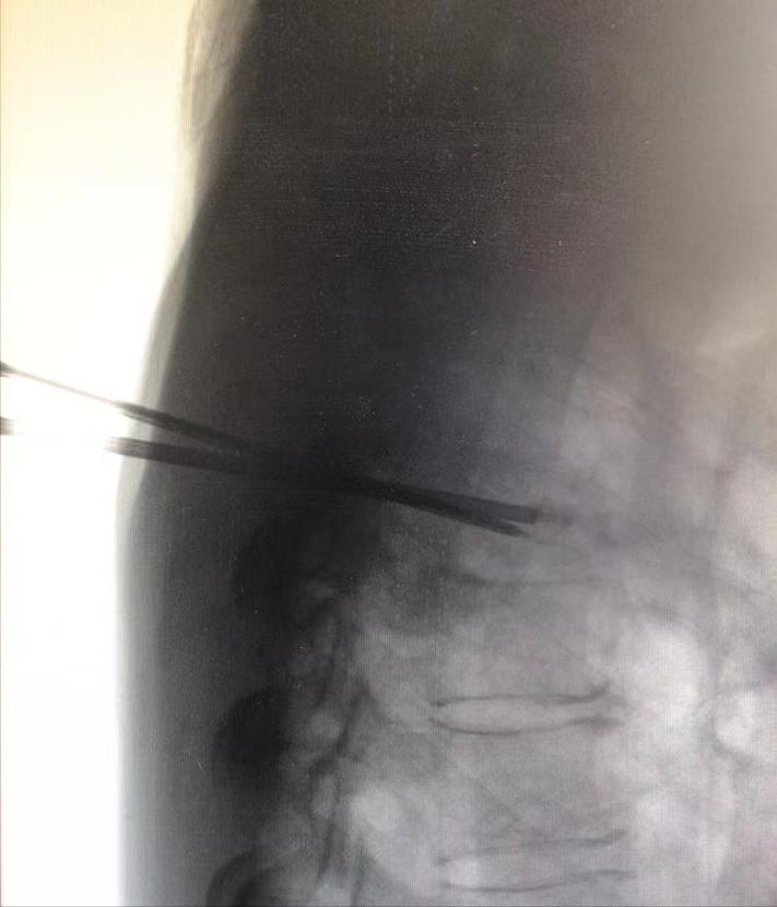 胸椎压缩性骨折微创手术利弊,胸椎压缩性骨折保守治疗20例