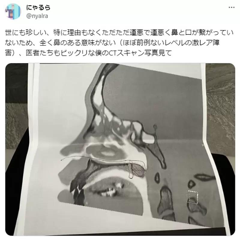 鼻子和嘴巴没味觉是什么情况,鼻子没有嗅觉有关系吗