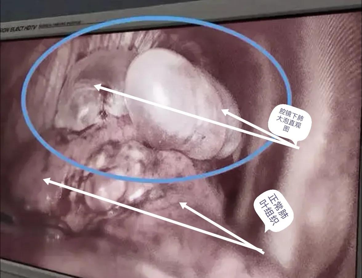 肺大泡产生的原因及治疗方案,肺大泡怎么治疗断根