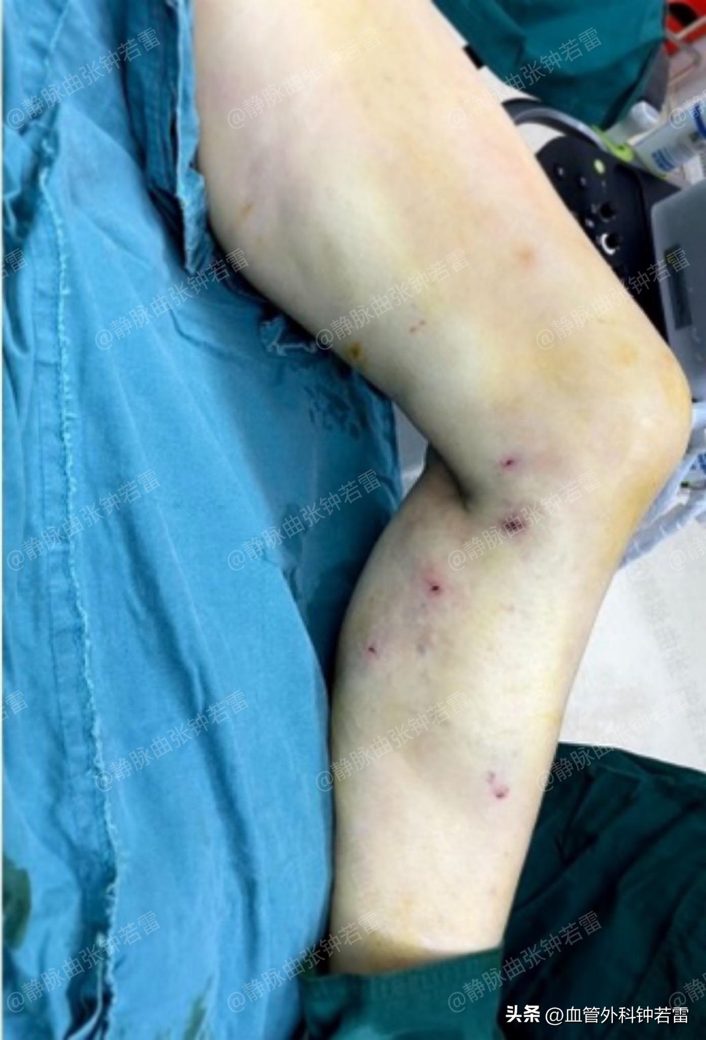 静脉曲张并发血管炎折磨了三代人，联合微创轻松告别“蚯蚓”！