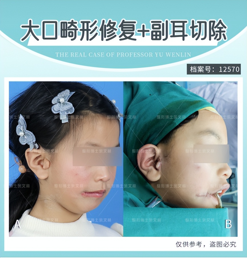 唇裂的分级,唇裂看病经验分享