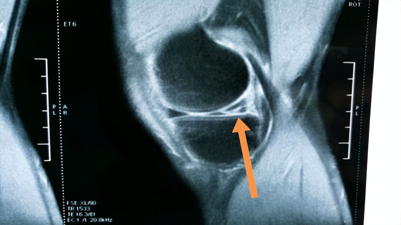 中老年膝盖半月板损伤的治疗方法,65岁老人半月板损伤膝盖痛
