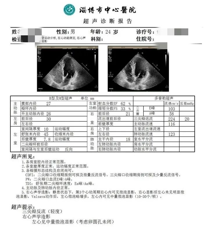中国卵圆孔未闭封堵手术第一例,哈医大卵圆孔未闭介入封堵术