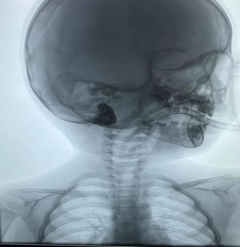 儿童耳后淋巴结中医治疗方法,小孩耳后长了一个淋巴管瘤