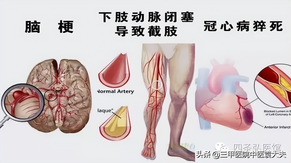中医专治抑郁症的方法,中医治疗焦虑抑郁症彻底根除案例