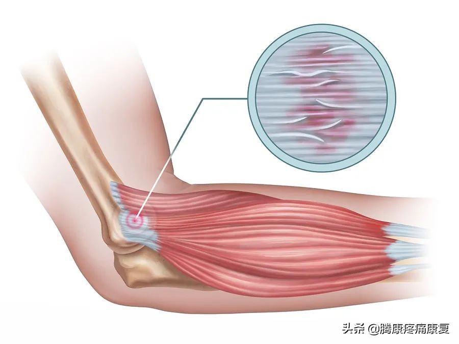 前臂疼痛，这五个动作就能缓解