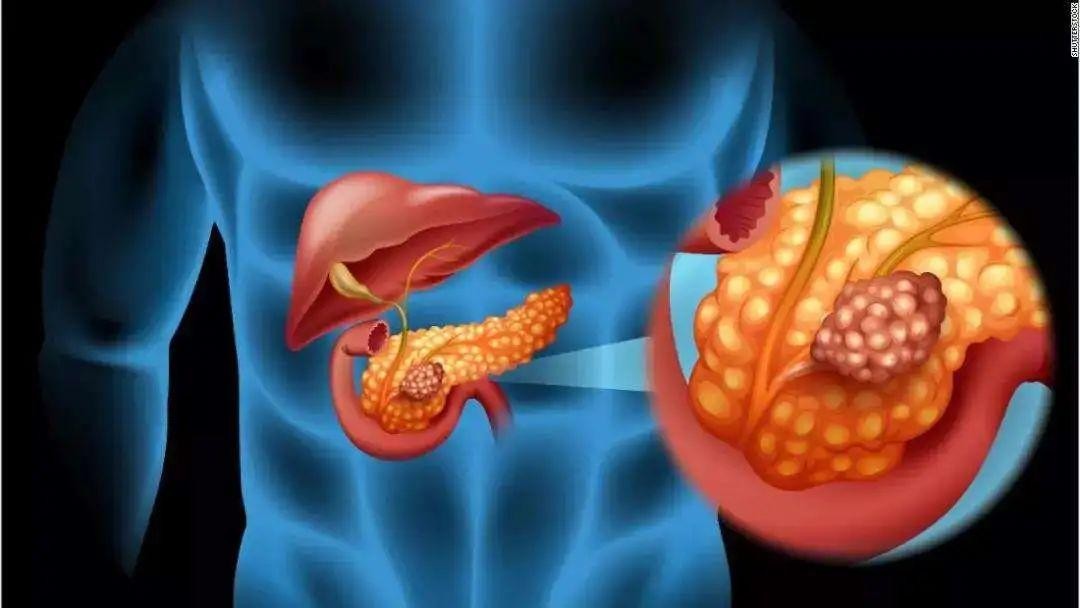 50岁男子肚子疼可能是癌症吗,男子肚子疼就检查出癌症