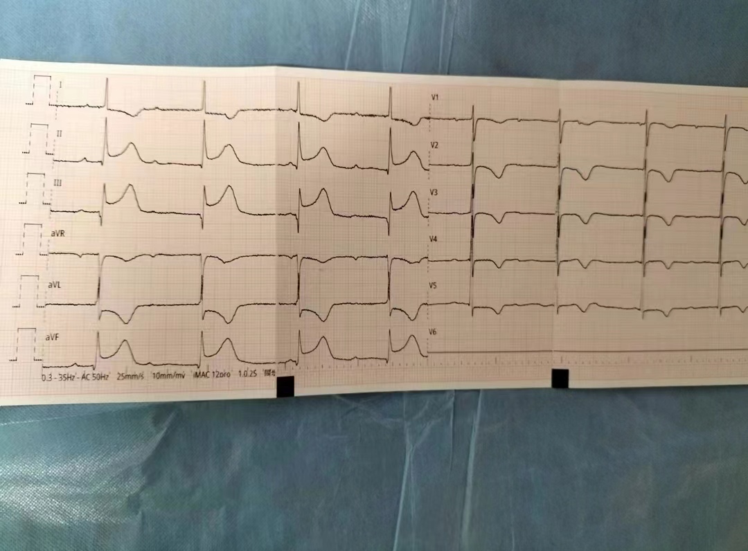 无缘无故肚子疼心梗,心脏疼警惕心梗