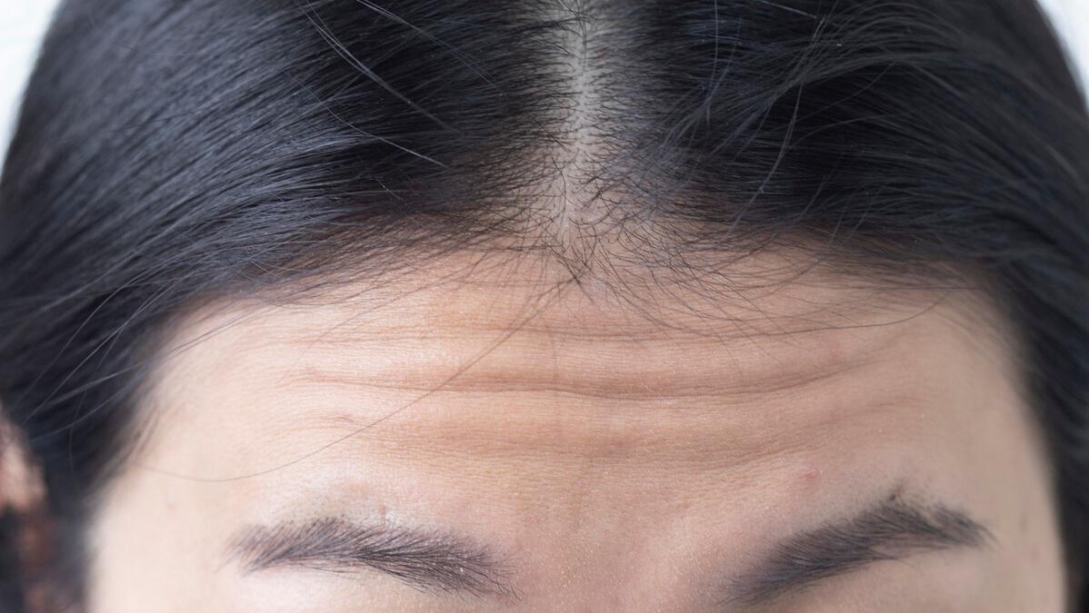 因为血管堵塞造成的抬头纹怎么办,抬头纹越多越容易心梗