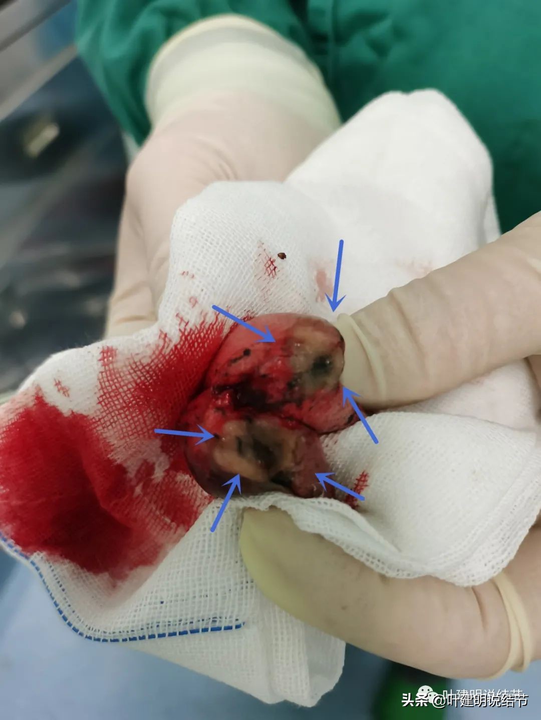 肺腺癌高危亚型什么意思,肺腺癌高危亚型