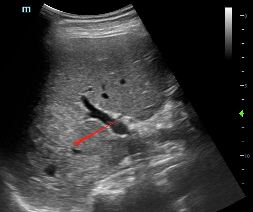 超声介入入门,手把手教你入门超声