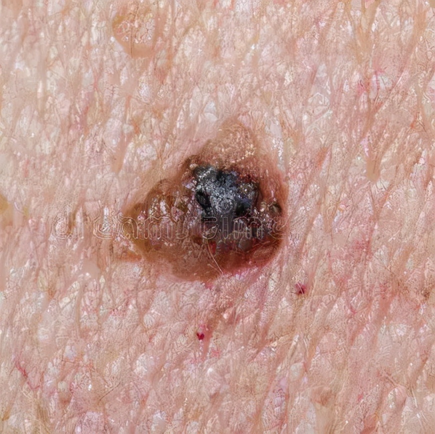 如何区别黑痣和黑色素瘤,怎么分清是黑色素瘤还是黑色的痣