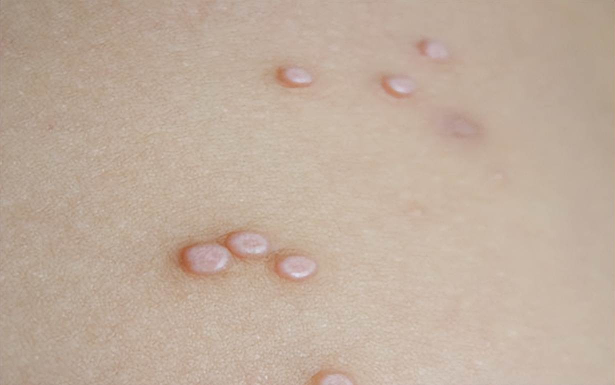 眼睛脖子眼皮有小肉粒是hpv吗,眼睛上的小肉粒是hpv