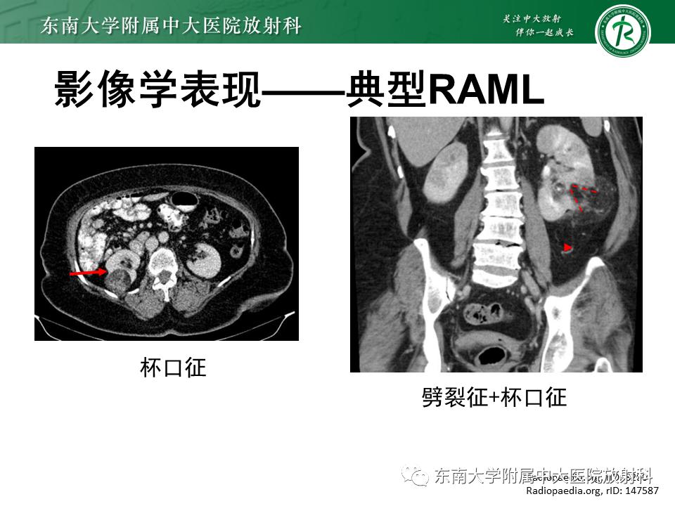 好文分享——《肾血管平滑肌脂肪瘤》