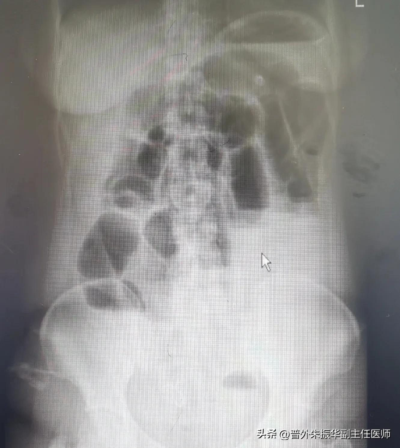 带您认识肠套叠是怎么回事？