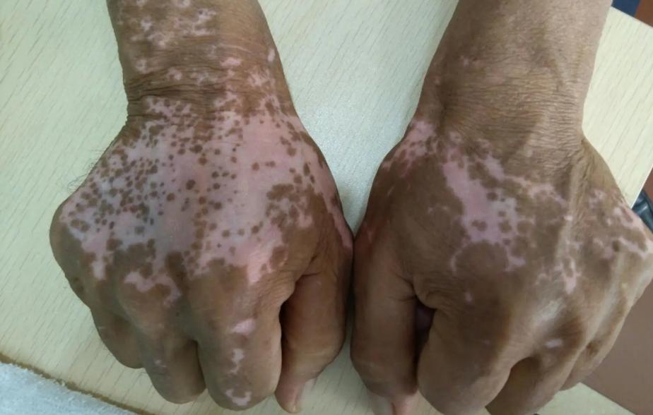 隐私部位的毛发变白，意味着体内有疾病吗？能不能刮掉？