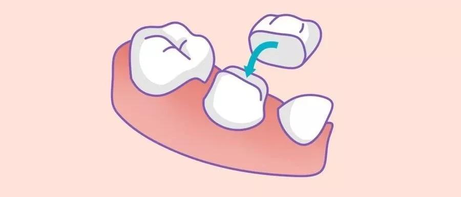 为什么牙医不提倡拔牙而是做牙冠,为什么牙医不想给病人做单冠