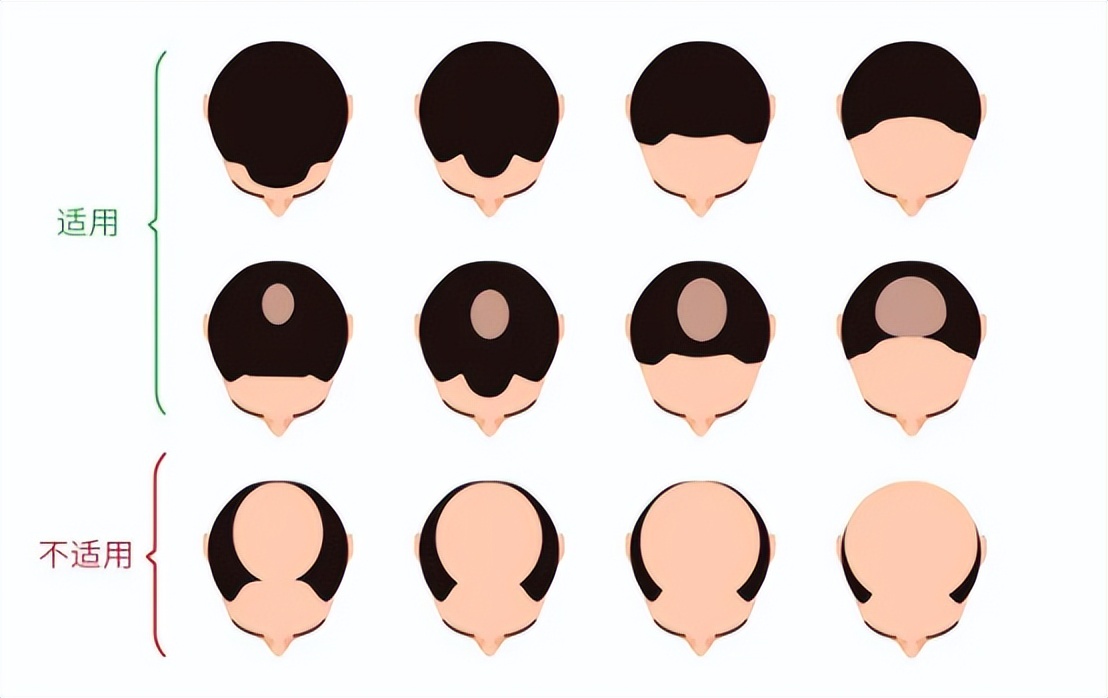 生发头盔生发仪真的有效果吗,激光生发仪是智商税吗