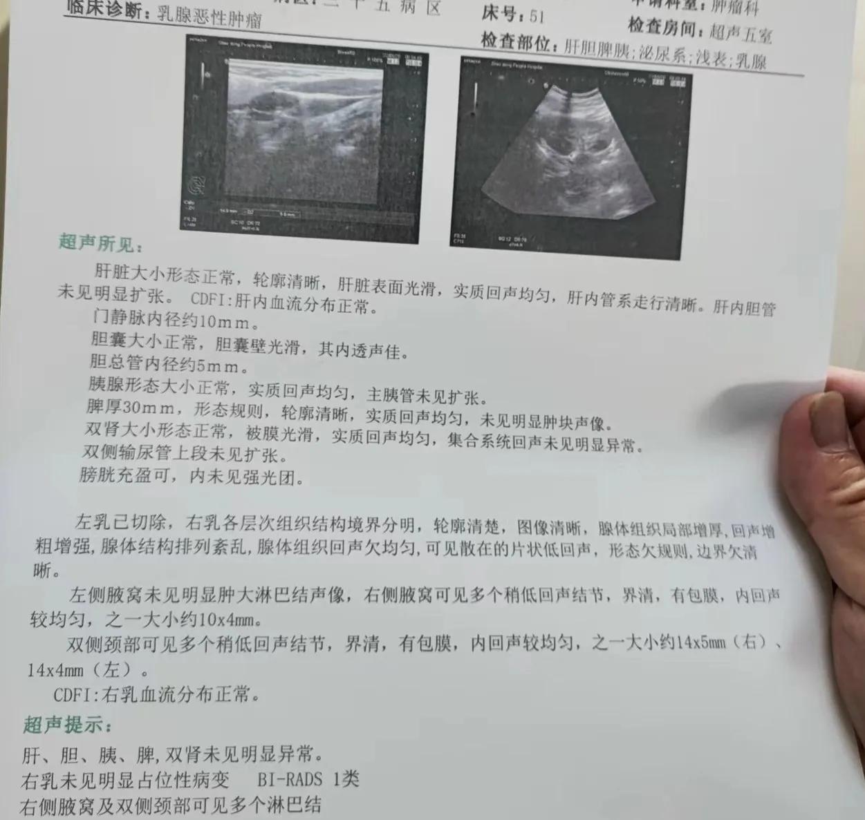 乳腺癌活过五年以后就痊愈了吗,乳腺癌骨转移有长期存活的吗