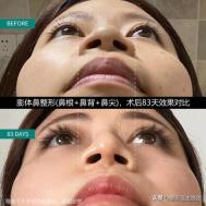 隆鼻后为什么没用夹板,隆鼻后鼻头感觉有点歪怎么办