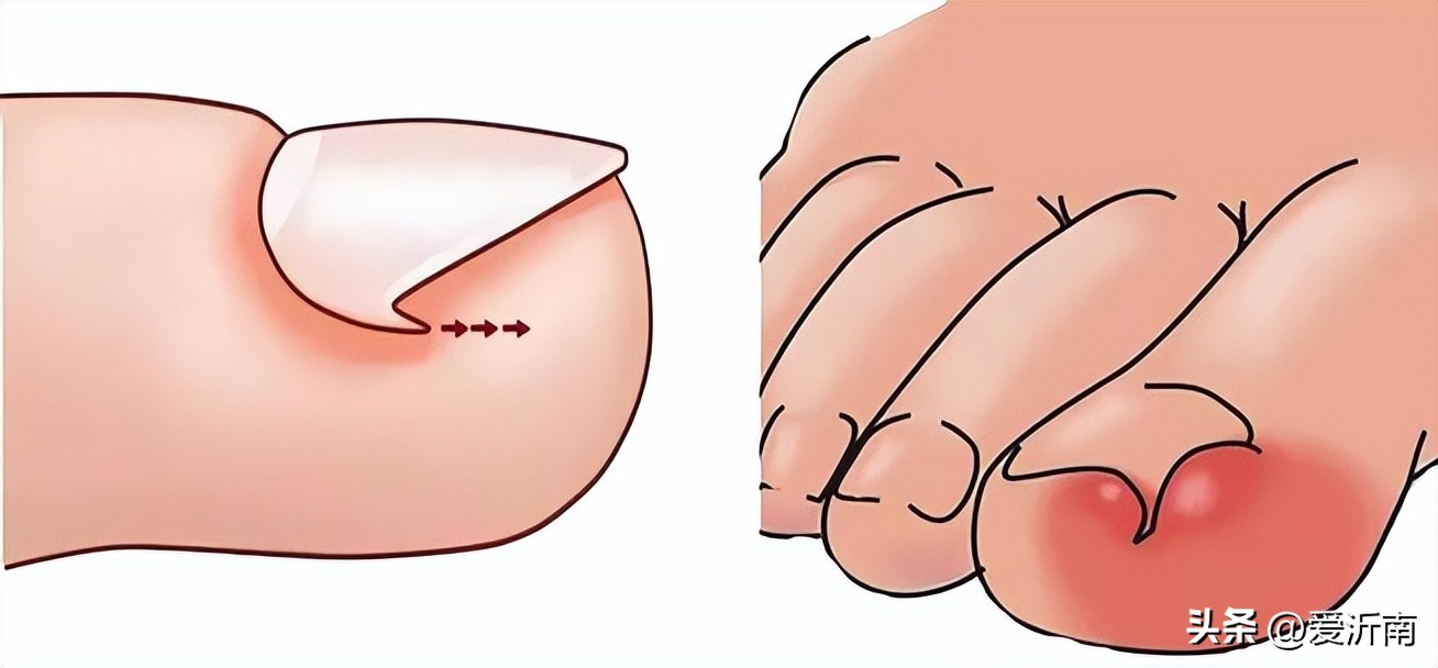 脚趾甲沟炎肿了怎么办一碰就疼,甲沟炎把指甲拔了还是肿