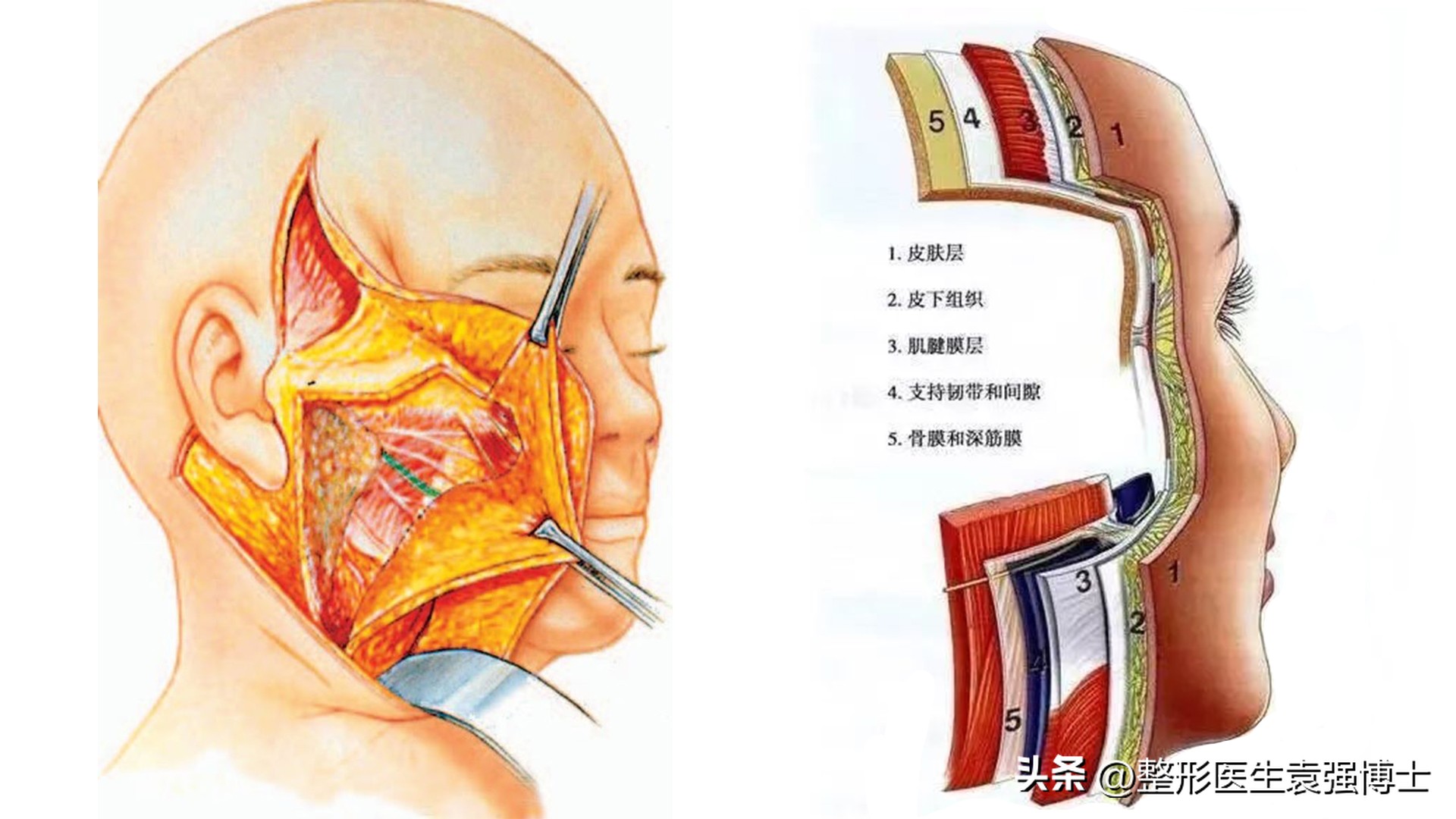 拉皮手术会加速衰老吗亲身经历,脸部松垮下垂拉皮还是填充