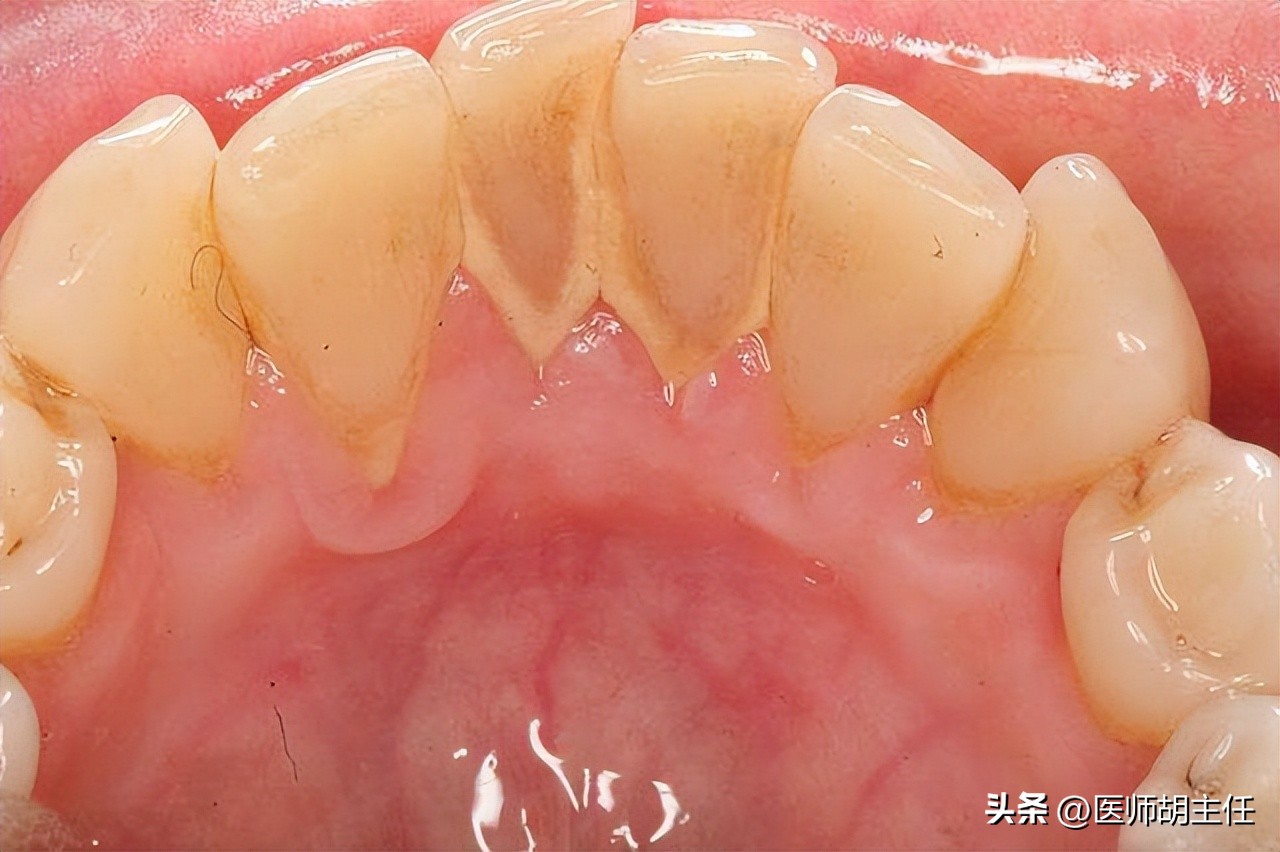 在牙缝里的牙结石要怎么去除,牙缝的牙结石怎么自己去除