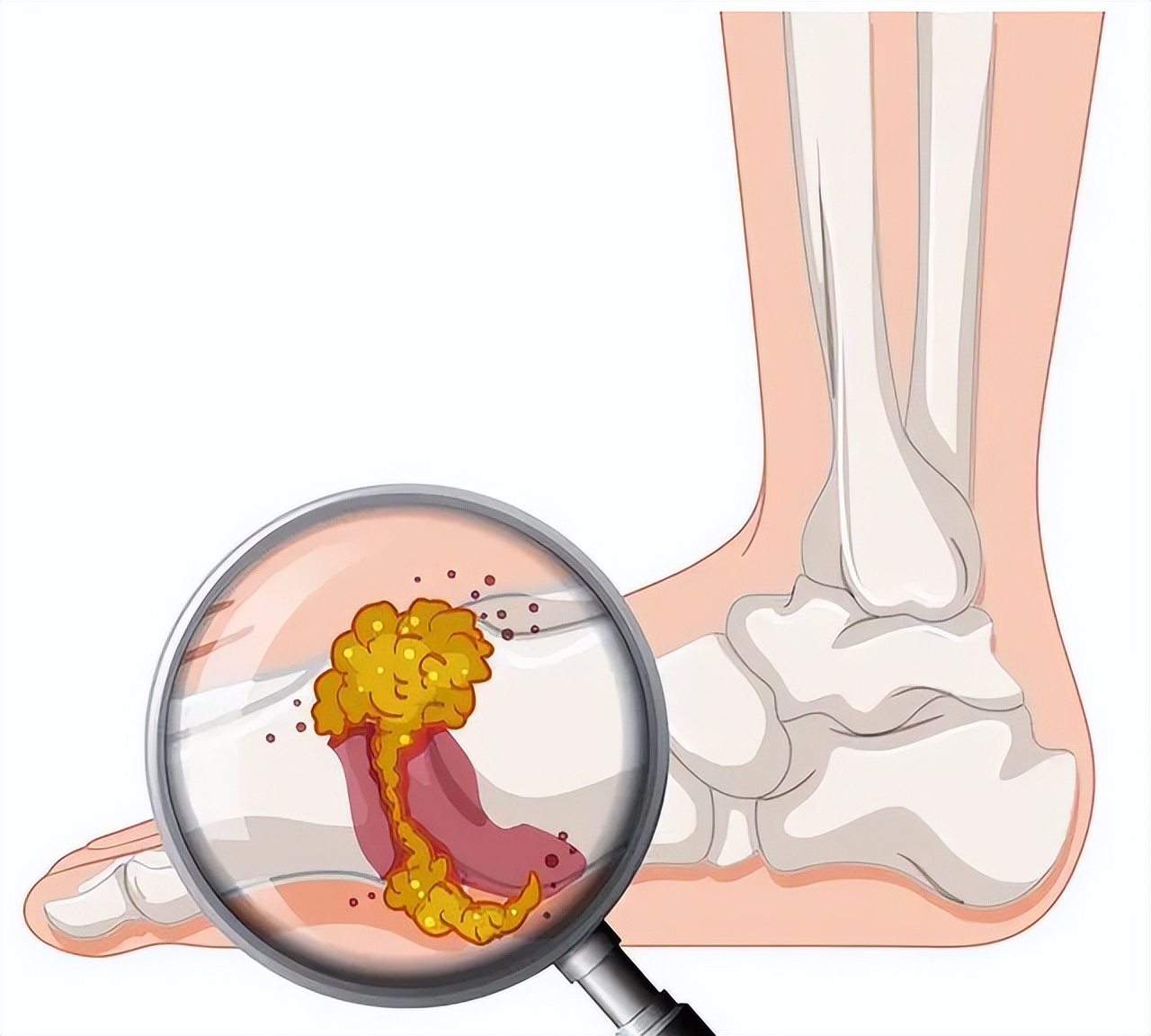 痛到疯的痛风如何预防,痛风脚上的痛风石怎么去