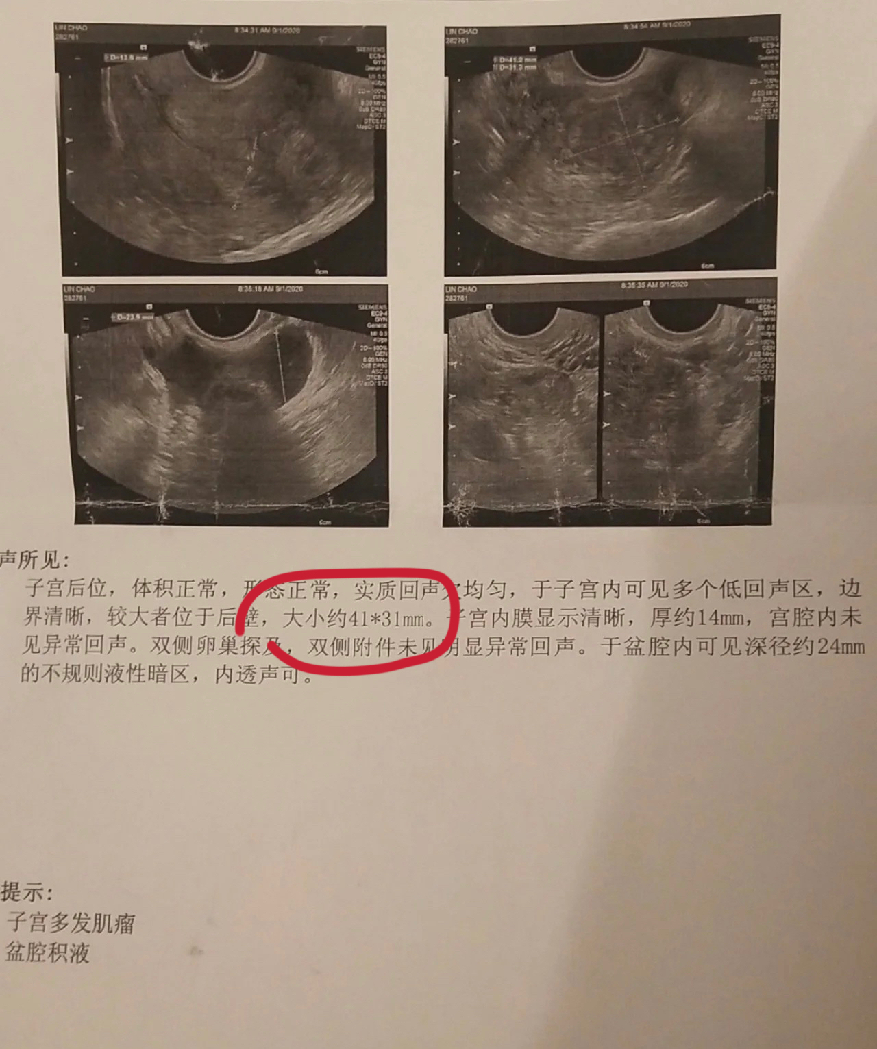 子宫肌瘤不手术,子宫肌瘤不开刀手术