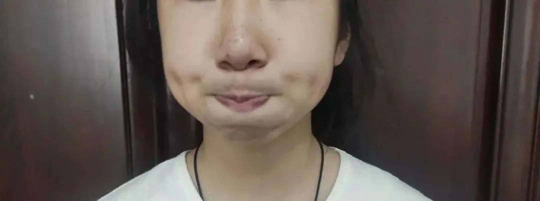 孩子嘴巴张不开发音小,小孩声带发育异常导致说话不清楚