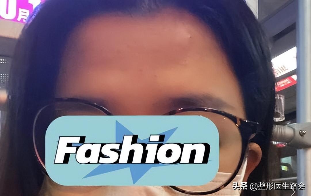 填充额头出现凹坑过于饱满,额头填充怎么避免踩坑