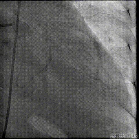 病例回顾与分享,腹膜后血肿介入治疗