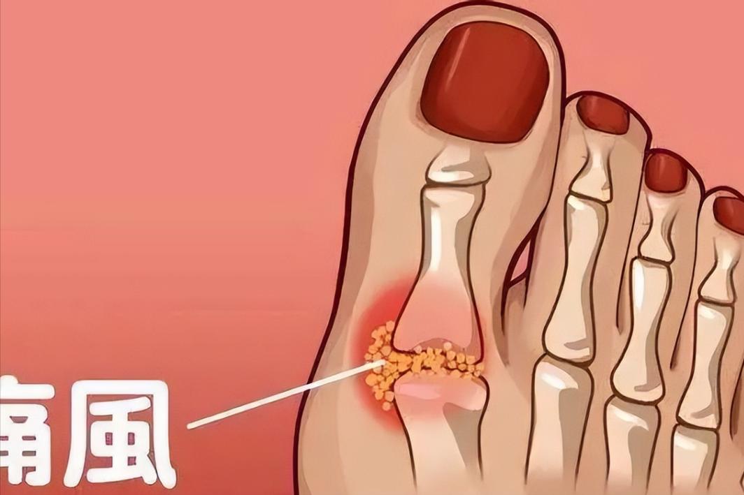 每天吃两片小苏打对痛风有好处吗,痛风吃小苏打片好还是非布司他好