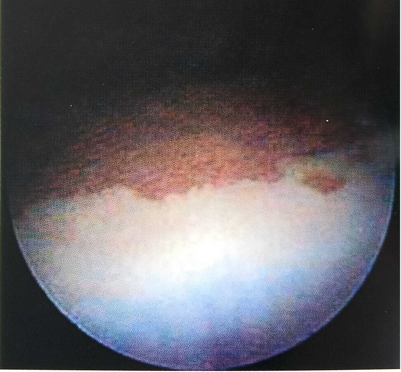 膀胱白斑电灼需要住院吗,膀胱白斑是什么