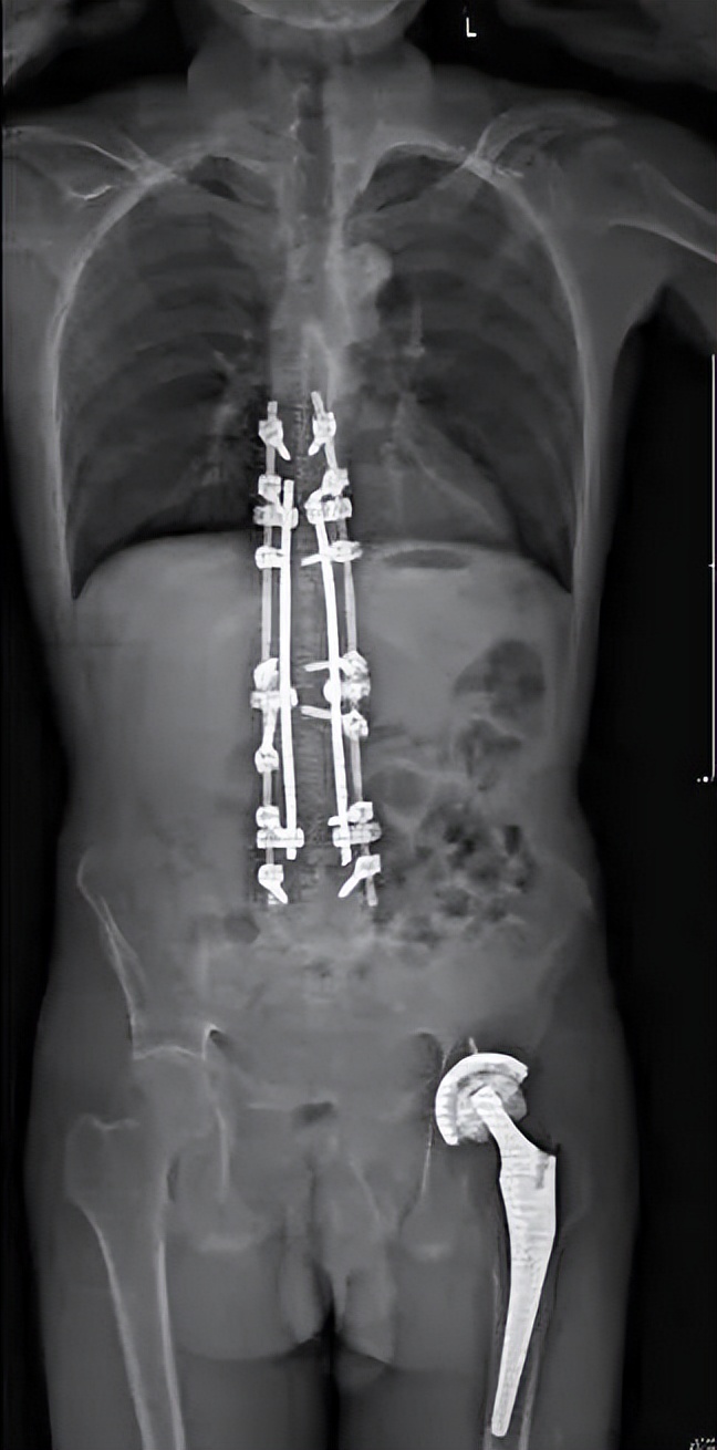 手术后平躺六小时睡着了,手术后终于睡着了