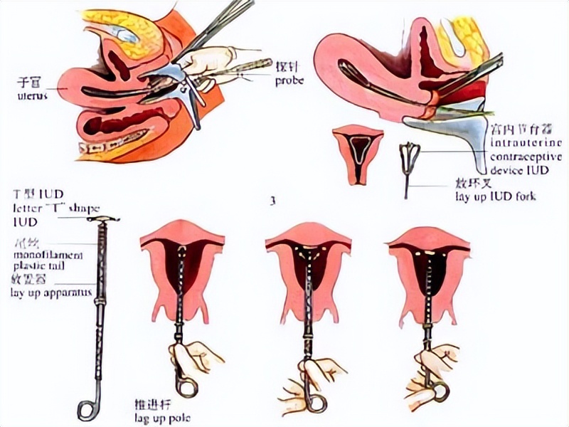 女性上环的全过程，看完心疼了！男女都要好好看看，珍惜眼前人