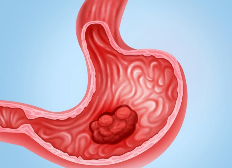 奥美拉唑系列胃药一二三级,奥美拉唑胃药吃多了有什么副作用