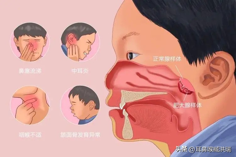 儿童腺样体肥大需要注意什么事项,饮食上怎样预防宝宝腺样体肥大